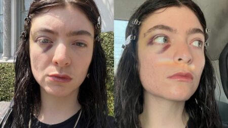 Lorde black eye