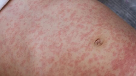 A stomach covered in red bumps resulting from measels as found in LA